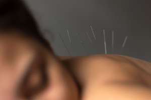 Acupuntura